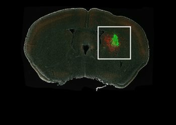 Why do gliomas tend to recur in the brain?