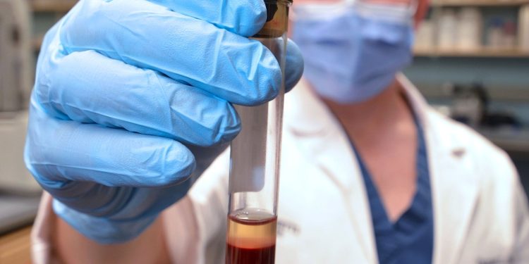 New blood test detects HPV-associated head and neck cancer 10 years early