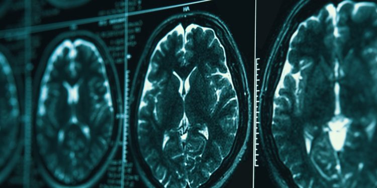 Making real gains in war on Alzheimer’s